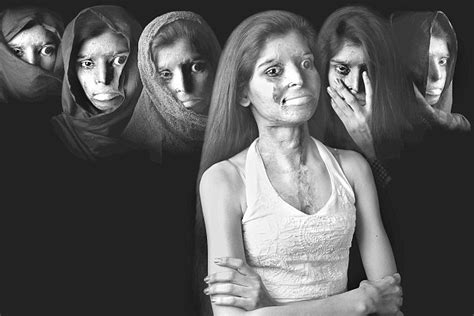 Acid Attack and its Aftermath: A Journey of Courage and Survival