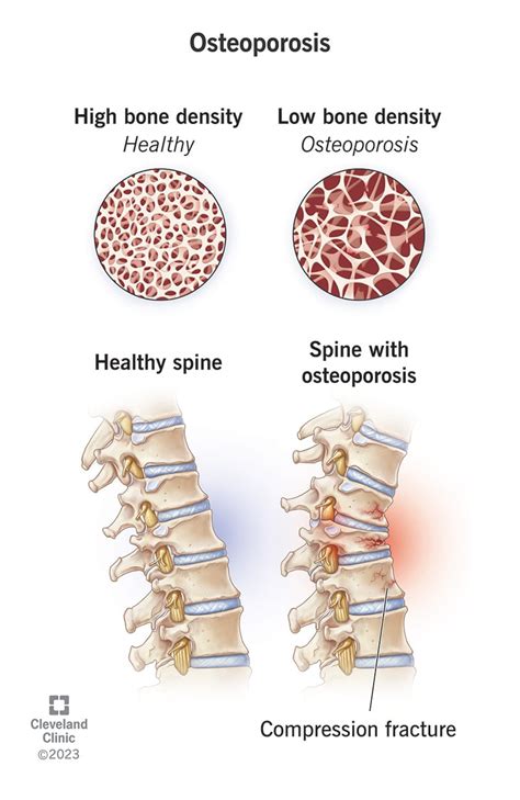 Improved Bone Density and Lowered Risk of Osteoporosis