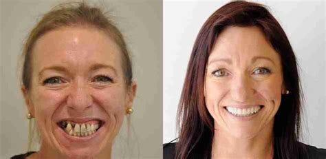 The Transformation: From Dental Challenges to a Fresh Look